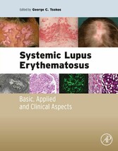 Systemic Lupus Erythematosus