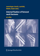 Internal fixation of femoral neck fractures