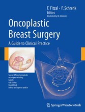 Oncoplastic Breast Surgery