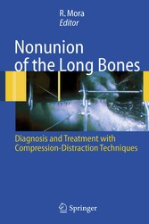 Nonunion of the Long Bones